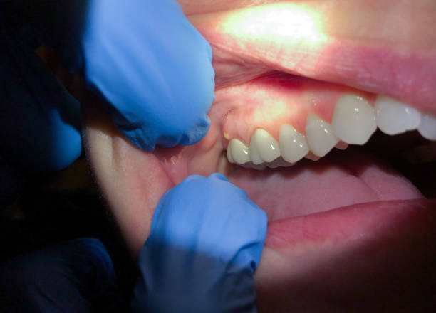 Best Emergency Dentist for Lost Fillings or Crowns in Placentia, CA