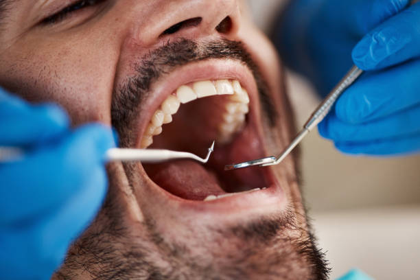 Best Broken or Cracked Tooth Emergency Dentist in Placentia, CA